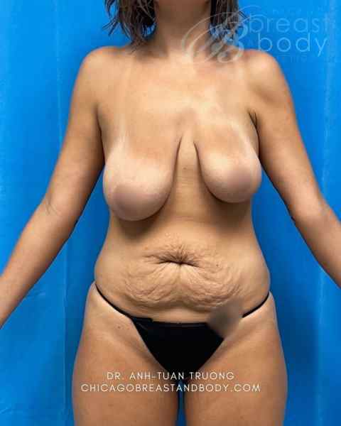 Abdominoplasty (Tummy Tuck), Mommy Makeover & Breast Lift with Implant before photo, actual patient, Case 2033782
