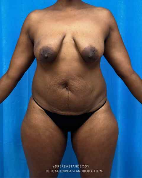 Abdominoplasty (Tummy Tuck), Mommy Makeover & Breast Lift with Implant before photo, actual patient, Case 2294674