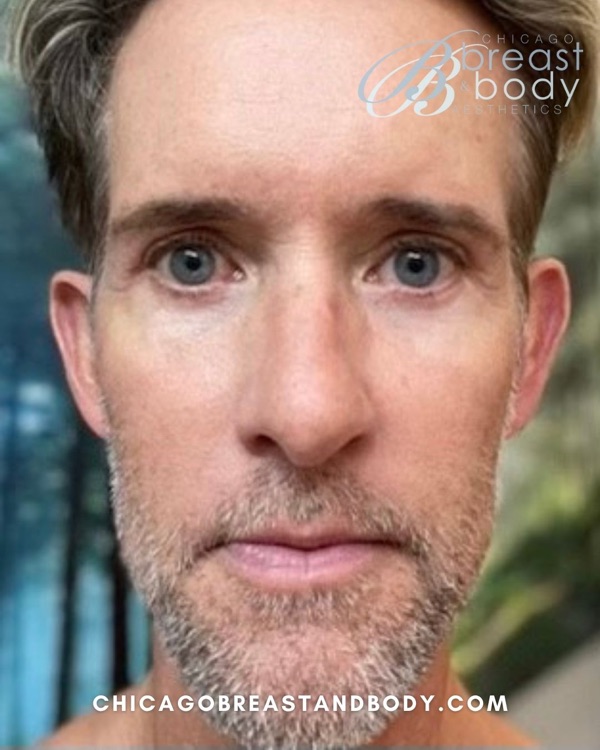 Patient after facelift surgery with Dr. Rachel