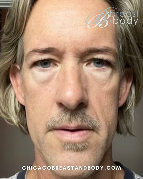 Patient before facelift surgery with Dr. Rachel