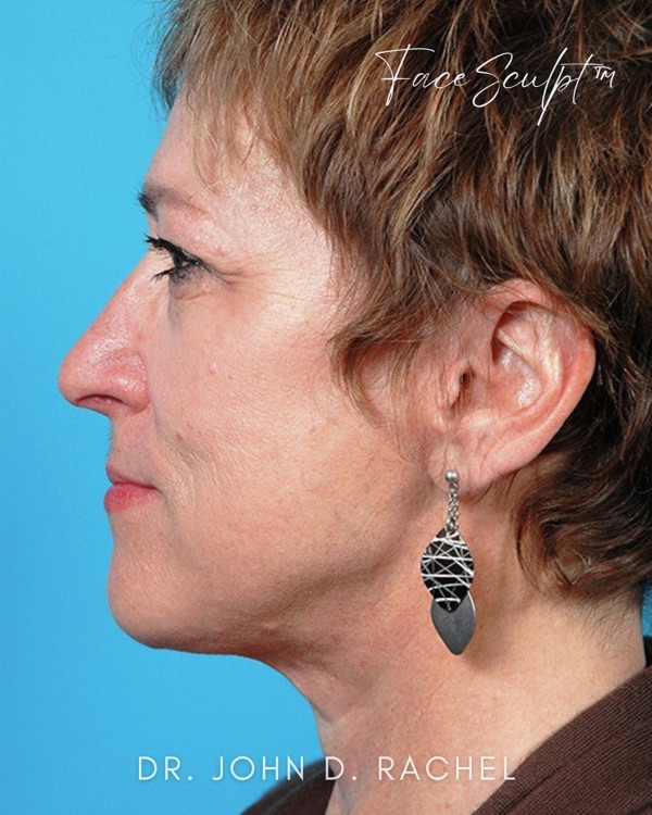 Patient after facelift surgery with Dr. Rachel