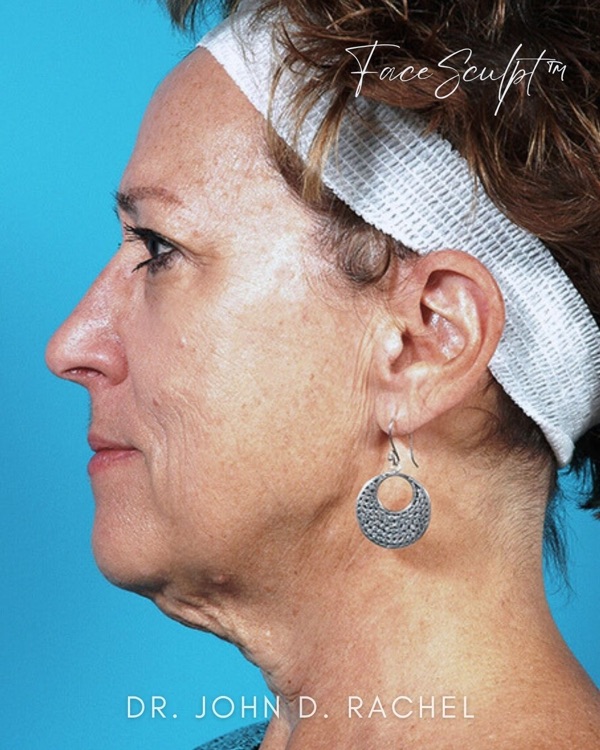 Patient before facelift surgery with Dr. Rachel