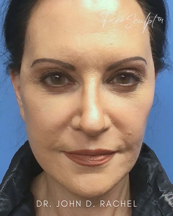 Patient after mini facelift surgery with Dr. Rachel