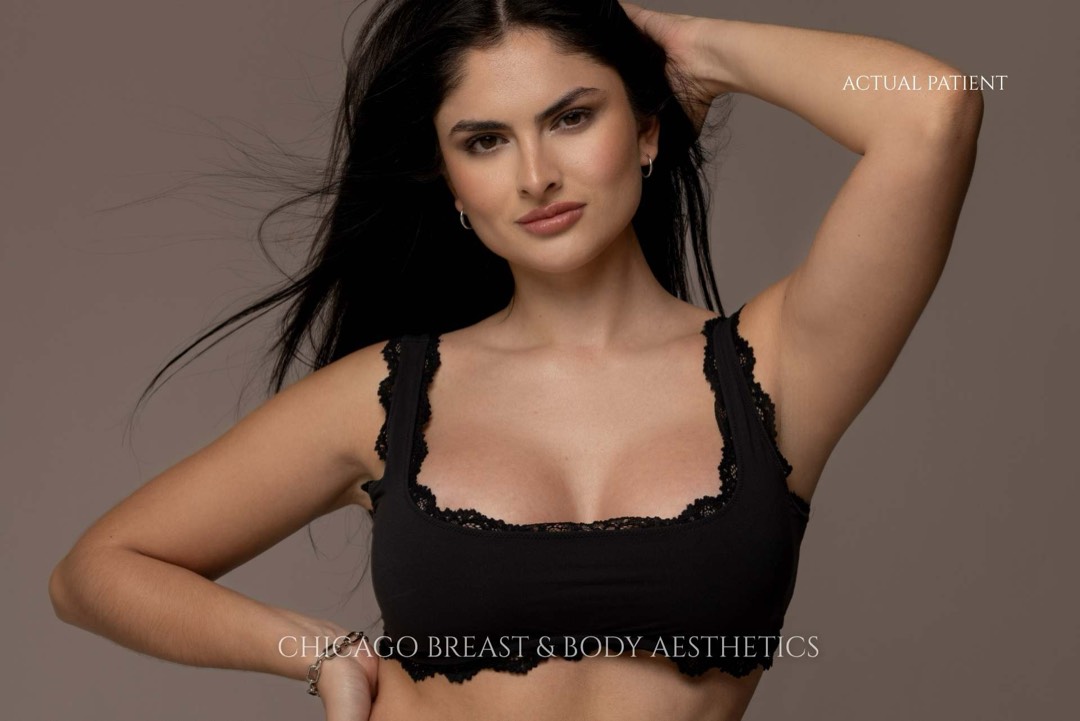 Breast augmentation surgery at Chicago Breast and Body Aesthetics